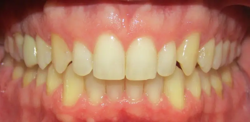 After Aligners