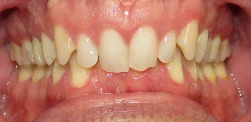 Before Aligners Before Aligners
