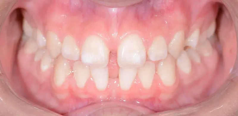 Before Aligners Before Aligners