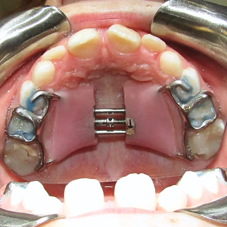 Expander